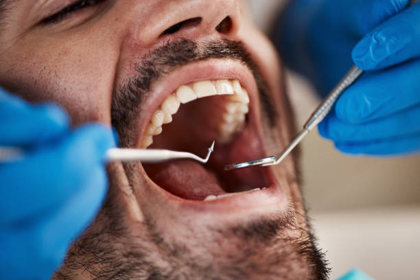 Best Knocked-Out Tooth (Avulsed Tooth) Treatment in Stanton, CA