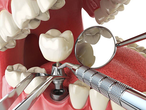 Best Emergency Wisdom Tooth Extraction in Stanton, CA
