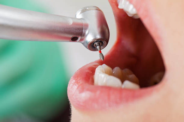 Best Emergency Dental Care for Sports Injuries in Stanton, CA